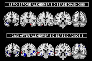 Alzheimer des dégâts plus précoces chez les femmes